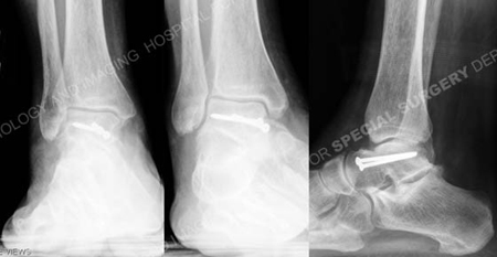 Lateral Talus Fracture