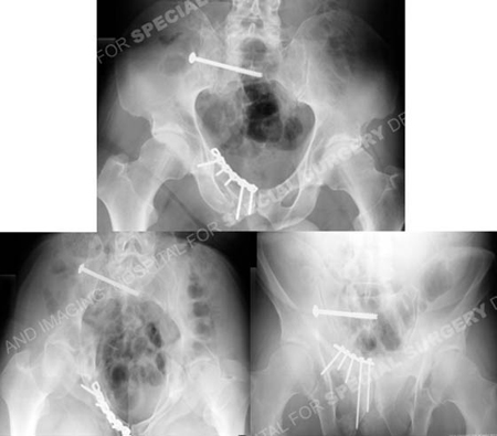 Postoperative radiographs at 6 months revealing healed pelvic fractures from a case example of polytrauma from the orthopedic trauma service at Hospital for Special Surgery.