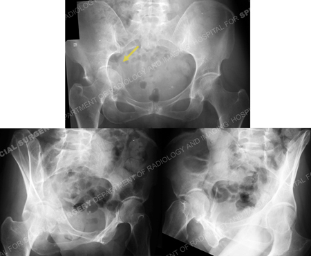 radiographs demonstrating acetabular fracture from a case example presented by the orthopedic trauma service at hospital for special surgery.