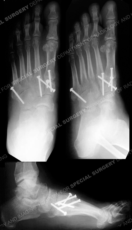 Anteroposterior, oblique and lateral radiographs at 3 months healing from a case example of lisfranc fracture dislocation from the orthopedic trauma service at Hospital for Special Surgery.