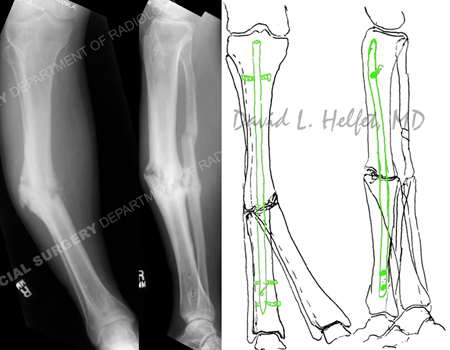 radiograph illustrating right-sided mid-shaft tibial nonunion with varus deformity from a case example for hospital for special surgery.