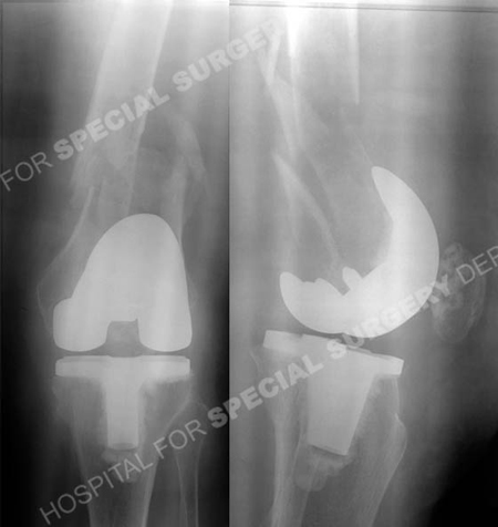 radiographs revealing a left-sided communited periprosthetic femur fracture from a case example presented by the orthopedic trauma service at Hospital for Special Surgery.