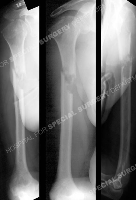 radiographs revealing right-sided pathologic mid-shaft humeral fracture from a case example presented by the orthopedic trauma service at Hospital for Special Surgery.