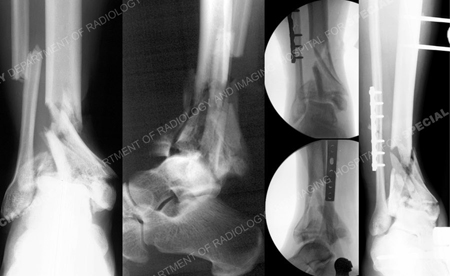 Radiographs at 5 months after the index surgery reveal a healed pilon fracture from a Case Example from Orthopedic Trauma Service at Hospital for Special Surgery.