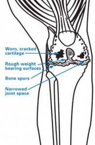 Total Knee Replacement - Damaged Knee Diagram