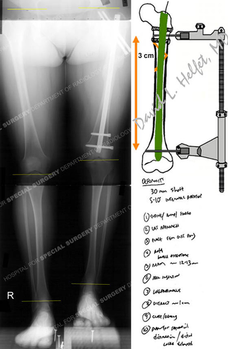 x-ray revealing subtrochanteric fracture from a case example on acute limb lengthening over an intramedullary nail from the orthopedic trauma service at Hospital for Special Surgery