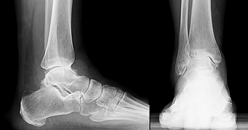 X-ray image showing ankle arthritis.