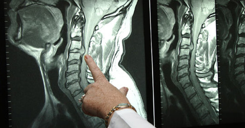 MRI imaging showing cervical meyelopathy.