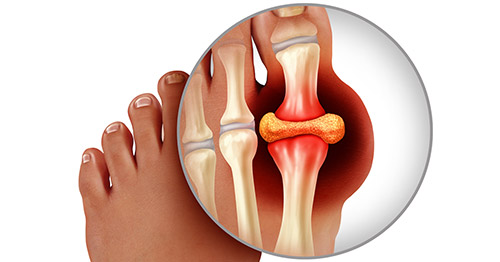 Illustration showing gout in the toe around the skeletal structures.