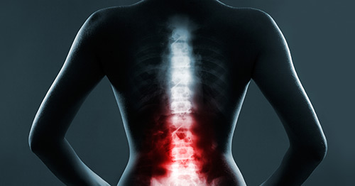 Artist's rendition of lumbar spine pain.