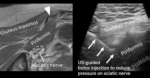 Ultrasound-guided botox injection of priformis muscle to alleviate sciatica.