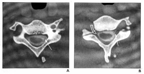 Figures A & B: CT myelogram showing a normal brachial plexus (left) and injured brachial plexus (right)