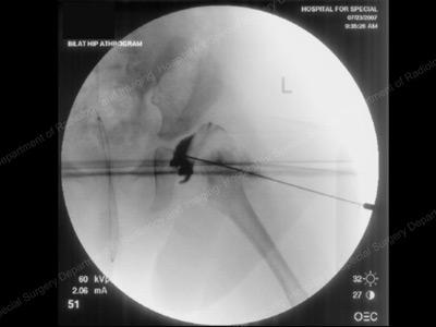Arthrogram image of dislocated hip in the operating room. Pediatric Hip Dysplasia