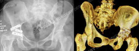 Radiograph and 3D CT reconstruction image revealing an acceptable reduction and placement of hardware from a case example presented by the orthopedic trauma service at Hospital for Special Surgery.