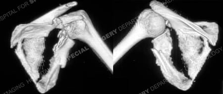 3-D CT scan showing scapula fracture with an associated clavicle fracture from a case example presented by the orthopedic trauma service at Hospital for Special Surgery.