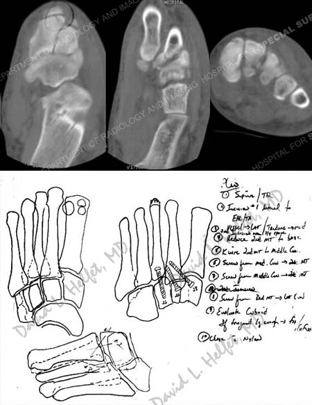 CT scan images further dilineating the fracture pattern and a pre-operative plan from a case example from the Orthopedic Trauma Service at Hospital for Special Surgery