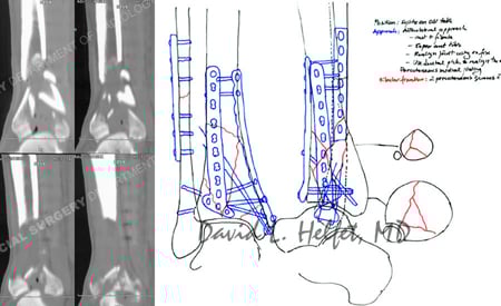 CT scan images further delineating the fracture pattern and pre-operative surgical plan from a Case Example of Distal Tibia (Pilon) Fracture from the Orthopedic Trauma Service at Hospital for Special Surgery.