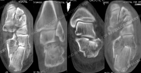 CT scan images delineating the calcaneus fracture from Case Example of Foot Fractures from Orthopedic Trauma Service at Hospital for Special Surgery.