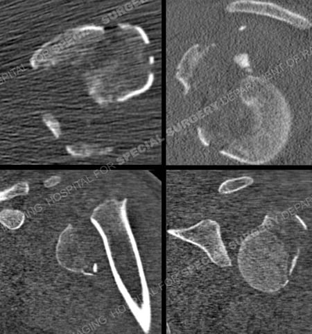 CT Scans revelaing proximal humerus fracture from a case example of should fracture from the orthopedic trauma service at Hospital for Special Surgery.