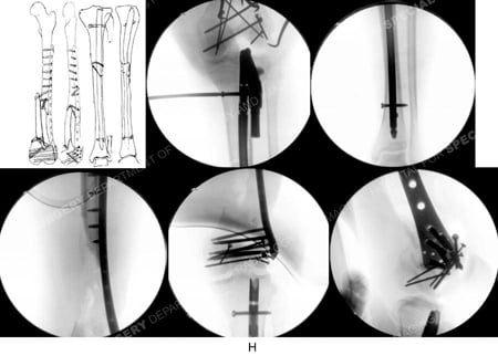 Fluoroscopic images showing placement of intramedullary nail from case example of distal femur fracture from hospital for special surgery.
