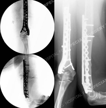 Intraoperative fluoroscopic AP and lateral images on left and radiographs at 6 months postoperative