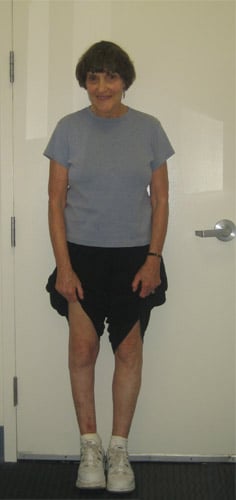 After photos of Correction of foot deformity with ankle fusion