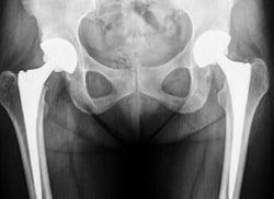 After photos of Bilateral total hip replacement