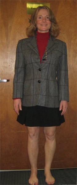 After photos of Tibia lengthening with the LATN technique