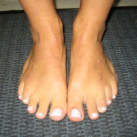 After photos of Bilateral metatarsal lengthening and tibial deformity corrections