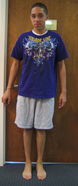 After photos of Massive 20 lengthening including femur lengthening over a nail