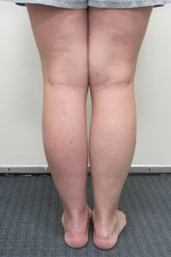 After photos of Bone transport and then nailing of the tibia