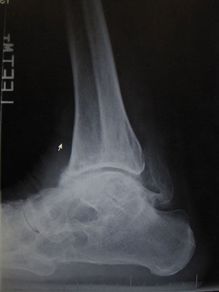 After photos of Ankle distraction for treatment of post-traumatic arthritis Before photo