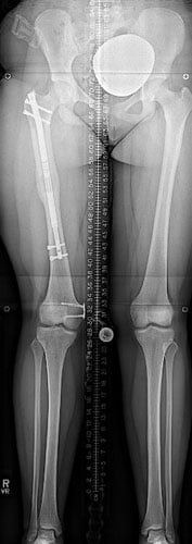 After photos of Femur lengthening with the Precice Internal Lengthening Nail