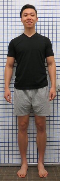 After surgery photo of Knock Knee