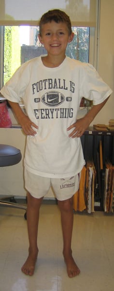 After photos of Lengthening and correction of femur after growth arrest