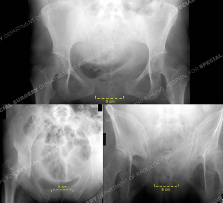 X-rays of the pelvis showing anteroposterior, inlet, and outlet views