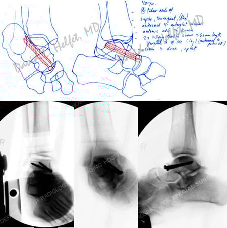 preoperative plan and fluoroscopic images following ORIF from a case example of a talus fracture from the orthopedic trauma service at Hospital for Special Surgery.