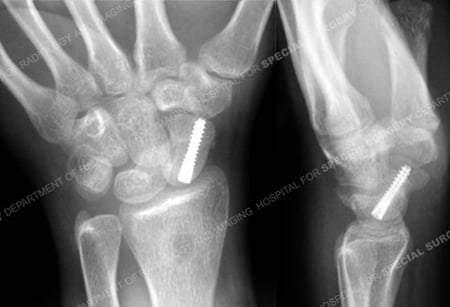 Anteroposterior lateral radiographs at 6 months illustrating a healed scaphoid fracture from a case example of Hand Fractures from the Orthopedic Trauma Service at Hospital for Special Surgery.