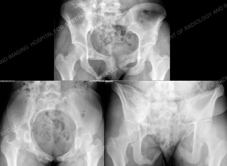 Pelvic radiographic x-rays removal of hardware from a case example presented by the orthopedic trauma service at Hospital for Special Surgery.