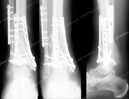 Radiographs at 5 months after the index surgery reveal a healed pilon fracture from a Case Example from Orthopedic Trauma Service at Hospital for Special Surgery.