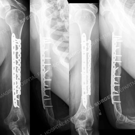 Radiographs at 7 weeks and 13 months illustrating healed humerus fracture from a case example presented by the orthopedic trauma service at Hospital for Special Surgery.