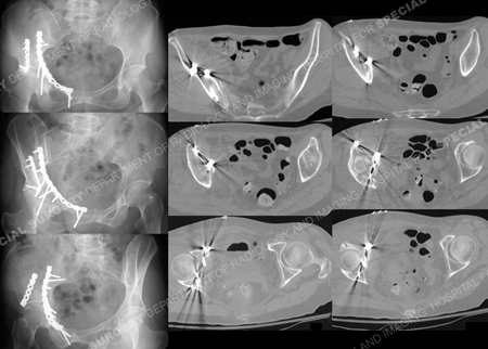 CT scans illustrating satisfactory reduction presented by the orthopedic trauma service at Hospital for Special Surgery.