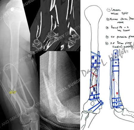 Radiographs reveal displaced humeral fracture with a medial butterfly fragment, from a case example of a humeral fracture from the orthopedic trauma service from Hospital for Special Surgery.