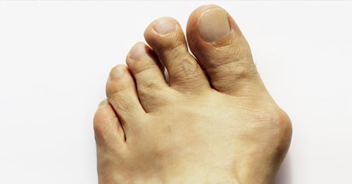 A foot with a bunion.