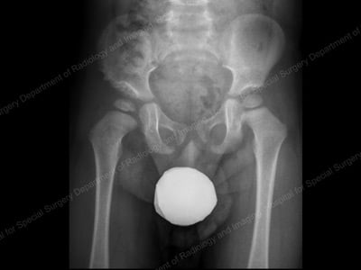 X-ray showing residual acetabular dysplasia on right side. Pediatric Hip Dysplasia