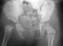 X-ray six months after open reduction with located right hip. Pediatric hip dysplasia
