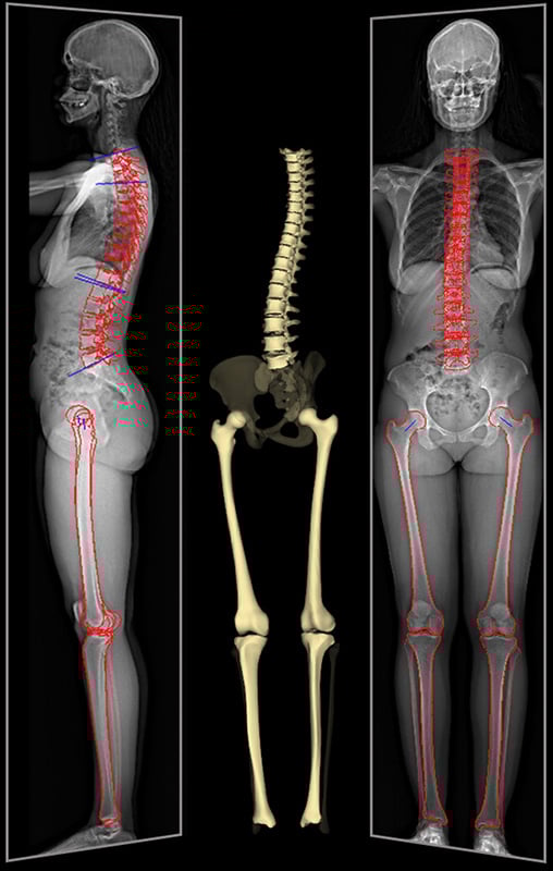 EOS full-body imaging of a patient with 2D low-dose X-ray and 3D rendering of the spine, hips and leg bones.