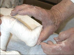 The final cast - Achilles tendon stretched further with forefeet pointed upward.