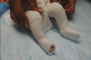 The Initial Ponseti Cast - Forefoot aligns with the heel, outer edge of foot tilts even further downward.