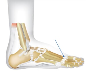 Illustration showing location of (first metatarsophalengeal joint (base of big toe) pain.